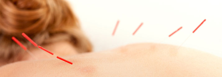 Chiropractic Liberty MO Acupuncture Relief Chiropractic Liberty MO Acupuncture Relief